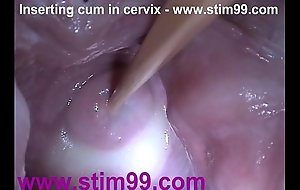 Flier sperm cum in cervix nigh dilatation twat reflector