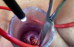 Inserting catheter into cervix